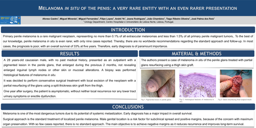 Preview of Melanoma in situ of the penis: a very rare entity with an even rarer presentation