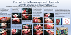 Thumbnail for Practical tips on the management of placenta accreta spectrum disorders
