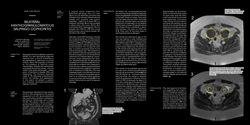 Thumbnail for A Rare Case Report of Bilateral Xanthogranulomatous Salpingo-Oophoritis