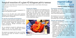 Thumbnail for Surgical resection of a massive 42-kilogram pelvic tumour
