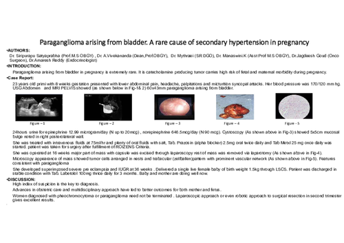 Preview of PARAGANGLIOMA ARISING FROM BLADDER - A RARE CAUSE OF SECONDARY HYPERTENSION IN PREGNANCY