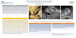 Thumbnail for A Wolf in Sheep’s Clothing: Not just a Tubo-ovarian Abscess