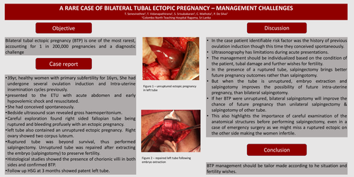 Preview of A rare case of bilateral tubal ectopic pregnancy – management challenges