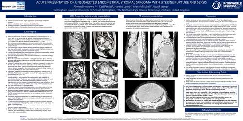 Preview of Acute presentation of unsuspected endometrial stromal sarcoma with uterine rupture and sepsis.