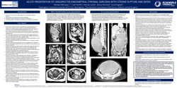Thumbnail for Acute presentation of unsuspected endometrial stromal sarcoma with uterine rupture and sepsis.