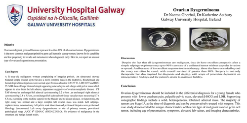 Preview of Ovarian Dysgerminoma