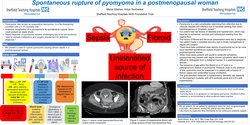 Thumbnail for Spontaneous rupture of pyomoma in a postmenopausal woman