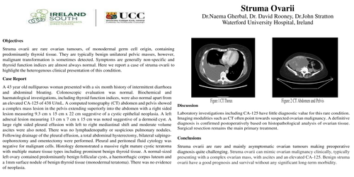 Preview of Struma Ovarii