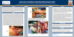 Thumbnail for A RARE CASE OF MINIMALLY CONJOINED OMPHALOPAGUS TWINS