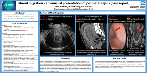 Preview of Fibroid migration causing an unusual presentation of postnatal sepsis: A case report.