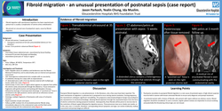 Thumbnail for Fibroid migration causing an unusual presentation of postnatal sepsis: A case report.