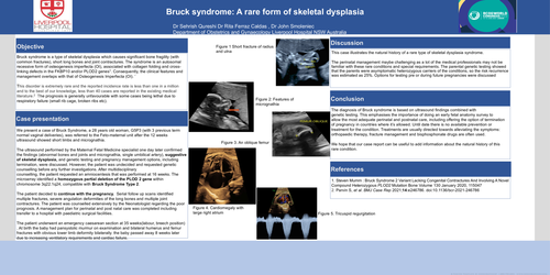 Preview of Bruck syndrome: A rare form of skeletal dysplasia