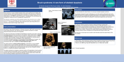 Thumbnail for Bruck syndrome: A rare form of skeletal dysplasia