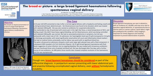 Preview of The broad-er picture: a large broad ligament haematoma following spontaneous vaginal delivery