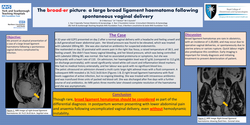 Preview of The broad-er picture: a large broad ligament haematoma following spontaneous vaginal delivery