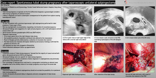 Preview of Spontaneous tubal stump pregnancy after laparoscopic unilateral salpingectomy