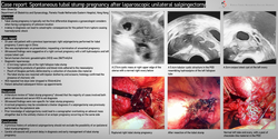 Thumbnail for Spontaneous tubal stump pregnancy after laparoscopic unilateral salpingectomy