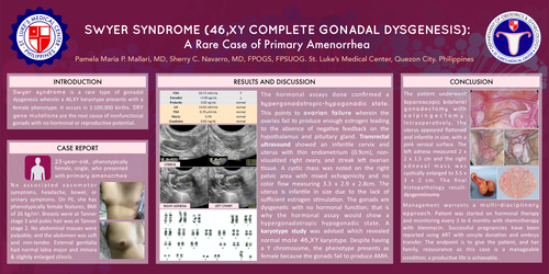 Preview of Swyer Syndrome (46,XY Complete Gonadal Dysgenesis):A Rare Case Of Primary Amenorrhea