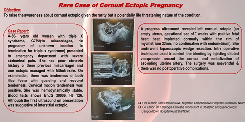 Preview of Rare Case of Cornual Ectopic Pregnancy: