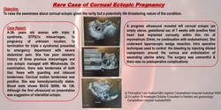 Thumbnail for Rare Case of Cornual Ectopic Pregnancy: