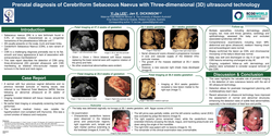 Preview of Prenatal diagnosis of Cerebriform Sebaceous Naevus with Three-Dimensional (3D) ultrasound technology