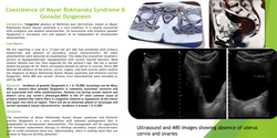 Thumbnail for Coexistence of Mayer- Rokitansky-Küster- Hauser Syndrome and Gonadal Dysgenesis.