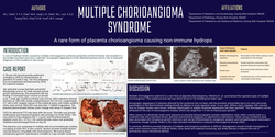 Preview of Multiple chorioangioma syndrome - a rare form of placenta chorioangioma causing non-immune hydrops