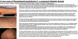 Thumbnail for A rare case of Pemphigoid gestationis in pregnant diabetic female