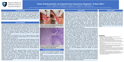 Thumbnail for VULVAR SCHISTOSOMIASIS; AN IMPORTANT BUT UNCOMMON DIAGNOSIS, “A NEAR MISS”