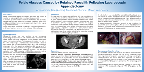 Preview of Pelvic abscess caused by retained fecalith following laparoscopic appendectomy.