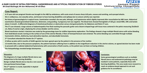 Preview of A rare cause of intra-peritoneal haemorrhage and atypical presentation of fibroid uterus.