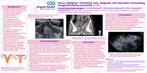 Preview of Uterus Didelphys: Prioritising Early Diagnosis and Education Surrounding Congenital Uterine Anomalies
