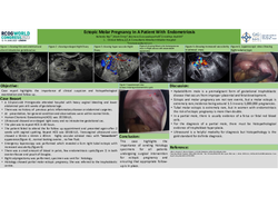 Thumbnail for Ectopic Molar Pregnancy in a patient with endometriosis