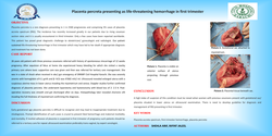 Thumbnail for Placenta percreta presenting as life-threatening hemorrhage in first trimester.
