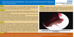 Thumbnail for Endometrial Osseous Metaplasia– Rare cause of Postmenopausal PV Bleeding