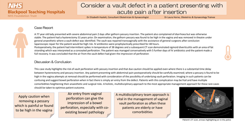 Preview of Consider a vault defect with acute pain after pessary insertion