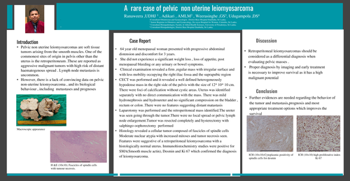 Preview of A rare case of pelvic non uterine leiomyosarcoma