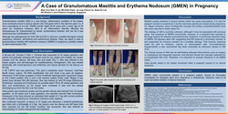 Thumbnail for A Case of Granulomatous Mastitis and Erythema Nodosum (GMEN) in Pregnancy