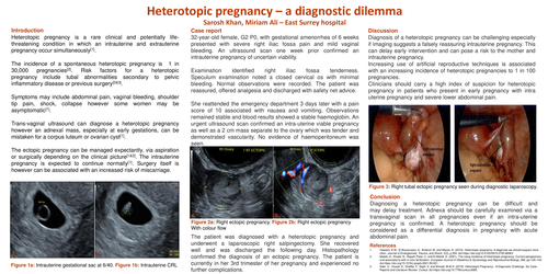 Preview of Heterotopic pregnancy -a diagnostic dilemma