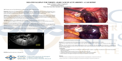 Thumbnail for ISOLATED FALLOPIAN TUBE TORSION: A RARE CAUSE OF ACUTE ABDOMEN