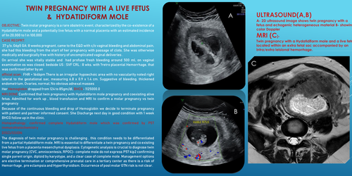 Preview of Twin pregnancy with Hydatidiform mole and Coexistent live fetus.
