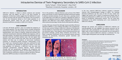 Thumbnail for Intrauterine Demise of Twin Pregnancy Secondary to SARS-CoV-2 Infection