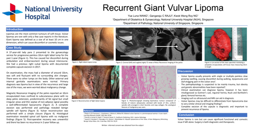 Preview of Recurrent Giant Vulvar Lipoma