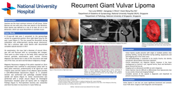 Thumbnail for Recurrent Giant Vulvar Lipoma