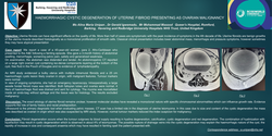 Thumbnail for HAEMORRHAGIC CYSTIC DEGENERATION OF UTERINE FIBROID PRESENTING AS OVARIAN MALIGNANCY
