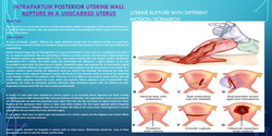Thumbnail for Intrapartum posterior uterine wall rupture in an unscarred uterus