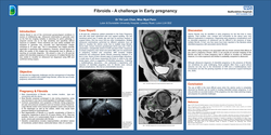 Thumbnail for Fibroids - A challenge in Early pregnancy