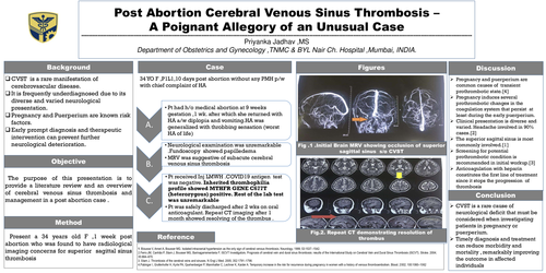 Preview of POST ABORTION CEREBRAL VENOUS SINUS THROMBOSIS -AN USUAL CASE