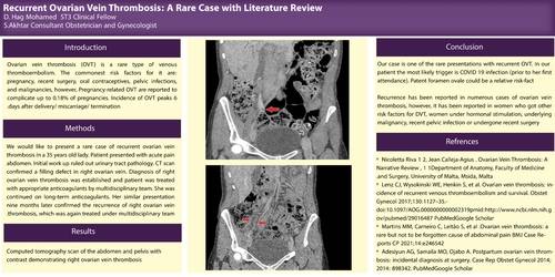 Preview of Recurrent Ovarian Vein Thrombosis: A Rare Case with Literature Review.