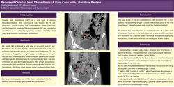 Thumbnail for Recurrent Ovarian Vein Thrombosis: A Rare Case with Literature Review.